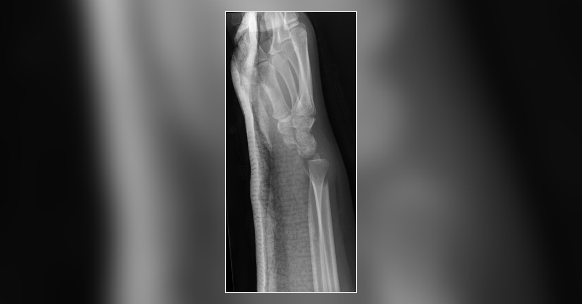 A Case Of Wrist Pain