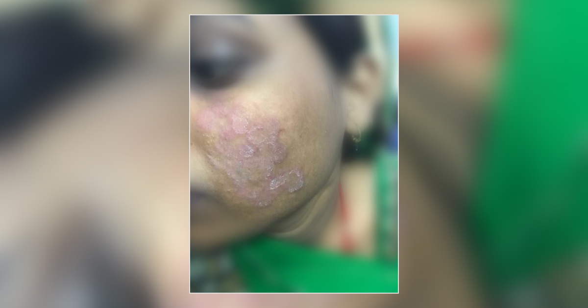 What Is This Skin Lesion On Face?