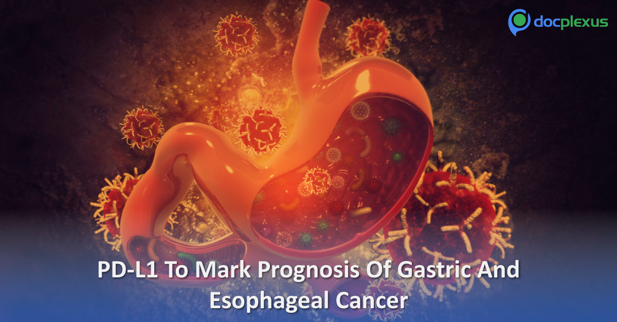 New Marker For Patients With Non-Metastatic AEG