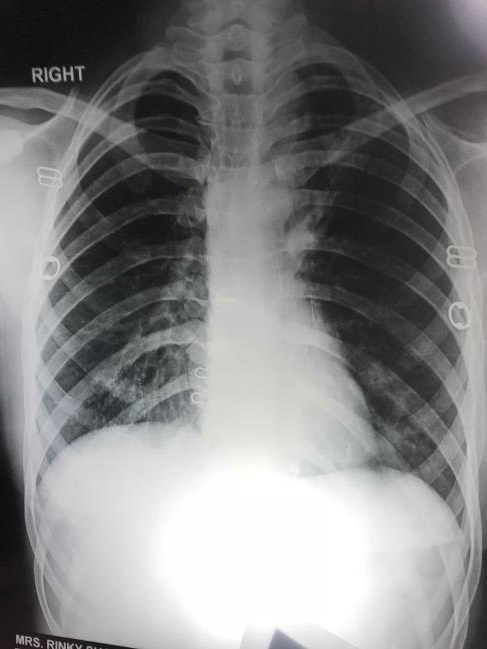 Provisional Diagnosis Of This X Ray?