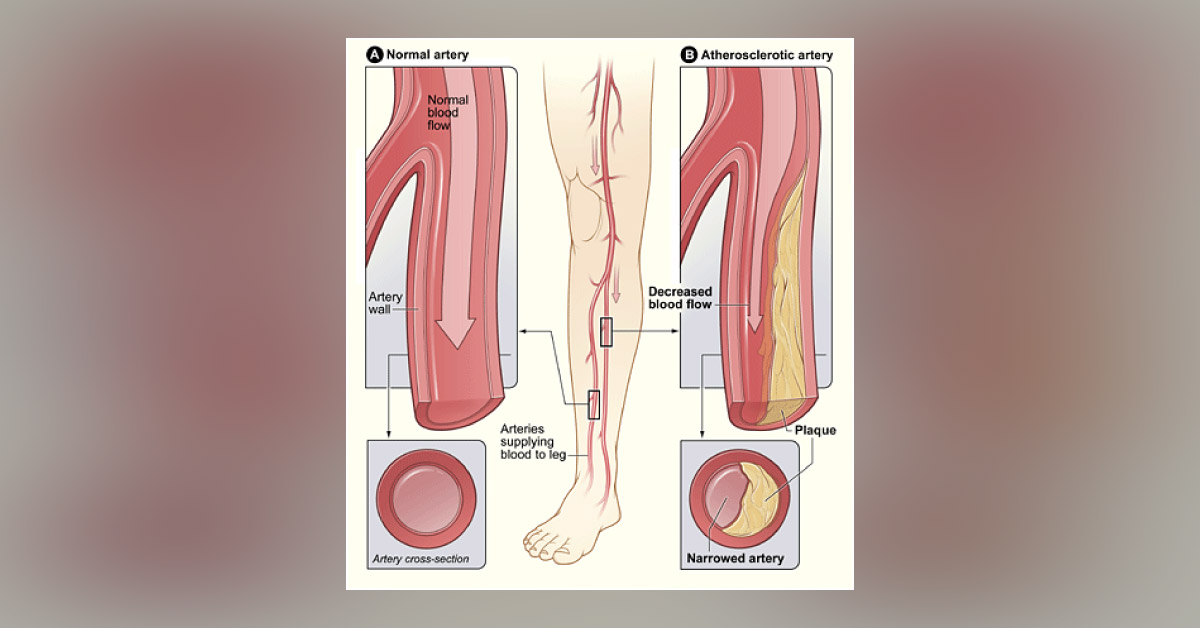Brief Review On Peripheral Vascular Disorders