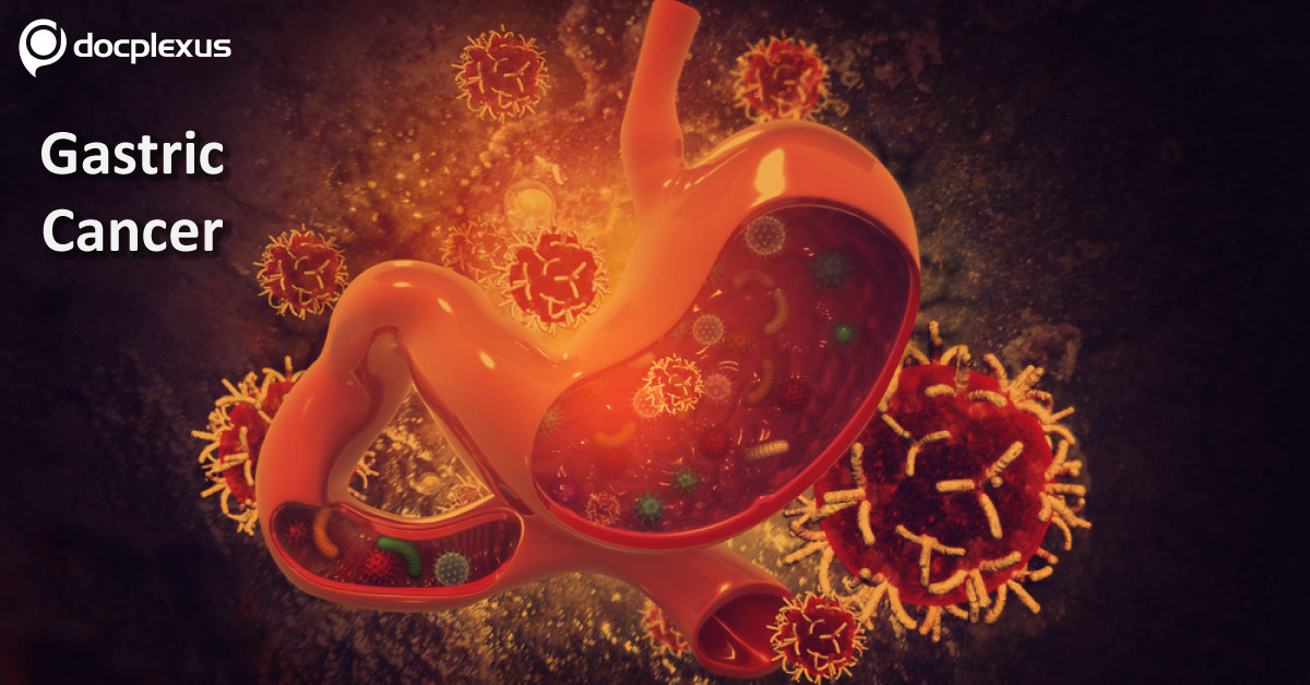 Gastric Cancer: Clinical Practice Guidelines