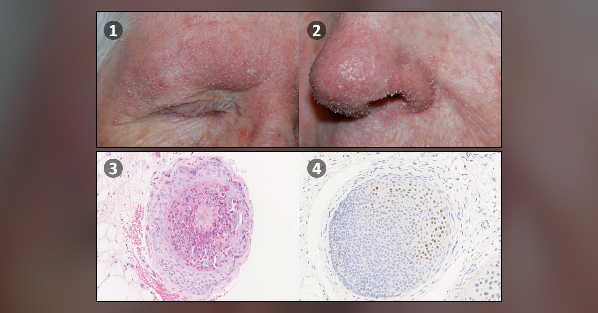Spiky Skin in a Renal Transplant Recipient