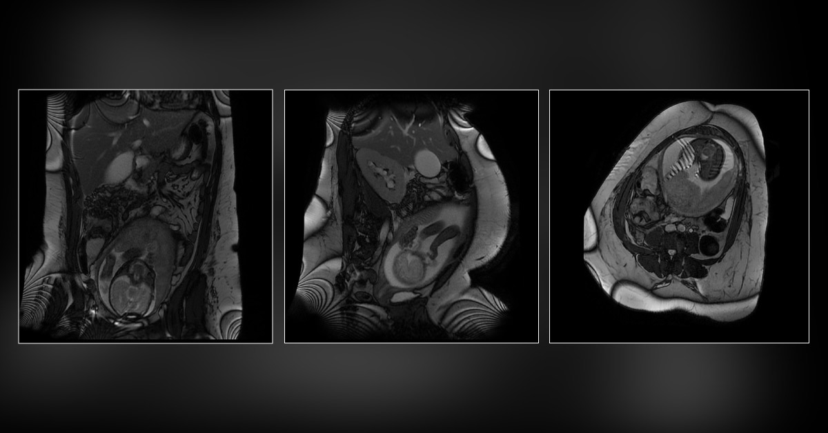 Which Acute Appendicitis Is This?