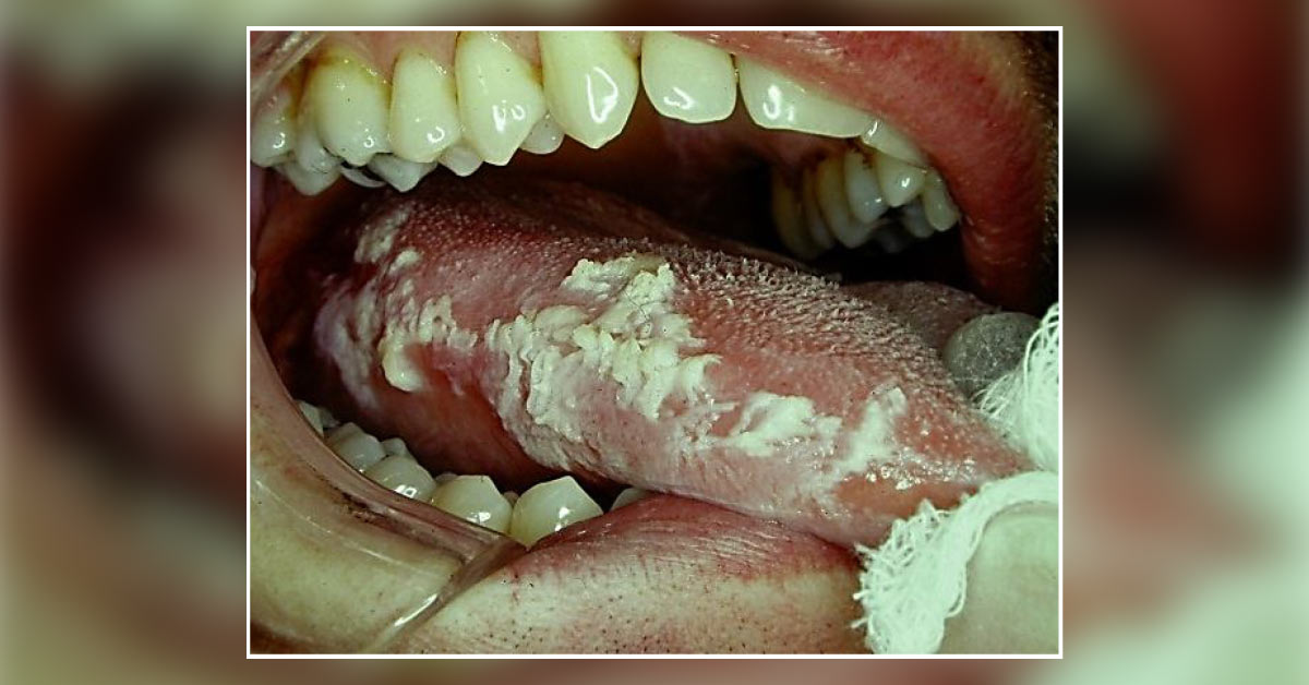 Case of an HIV-infected Patient with Ulcerations on the Tongue