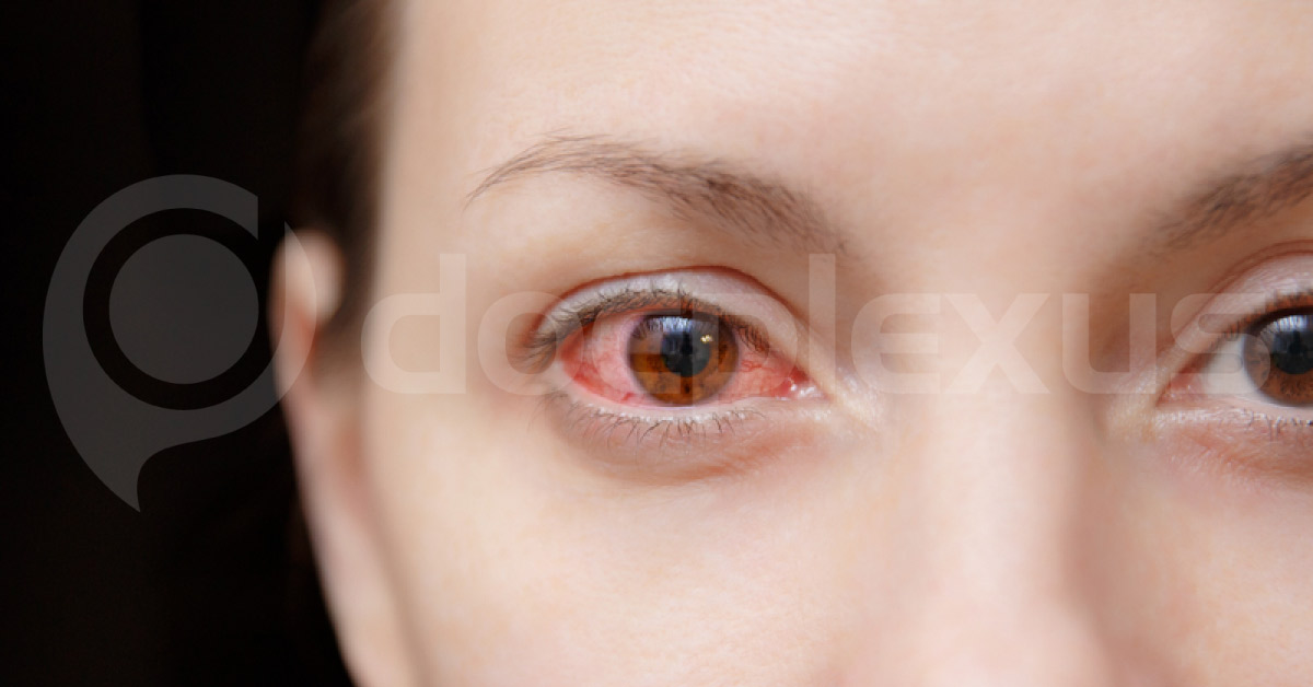 Brief Essay On Vernal Keratoconjunctivitis