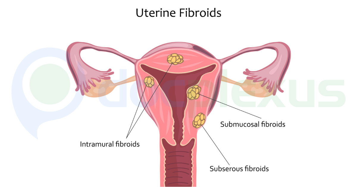 Ulipristal Acetate: A Novel Medical Therapy For Uterine Fibroids