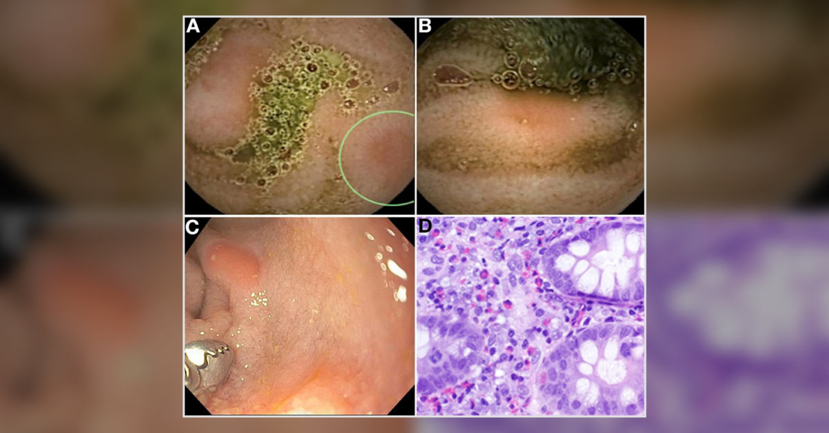 Eosinophilic Enteritis And Videocapsule Endoscopy