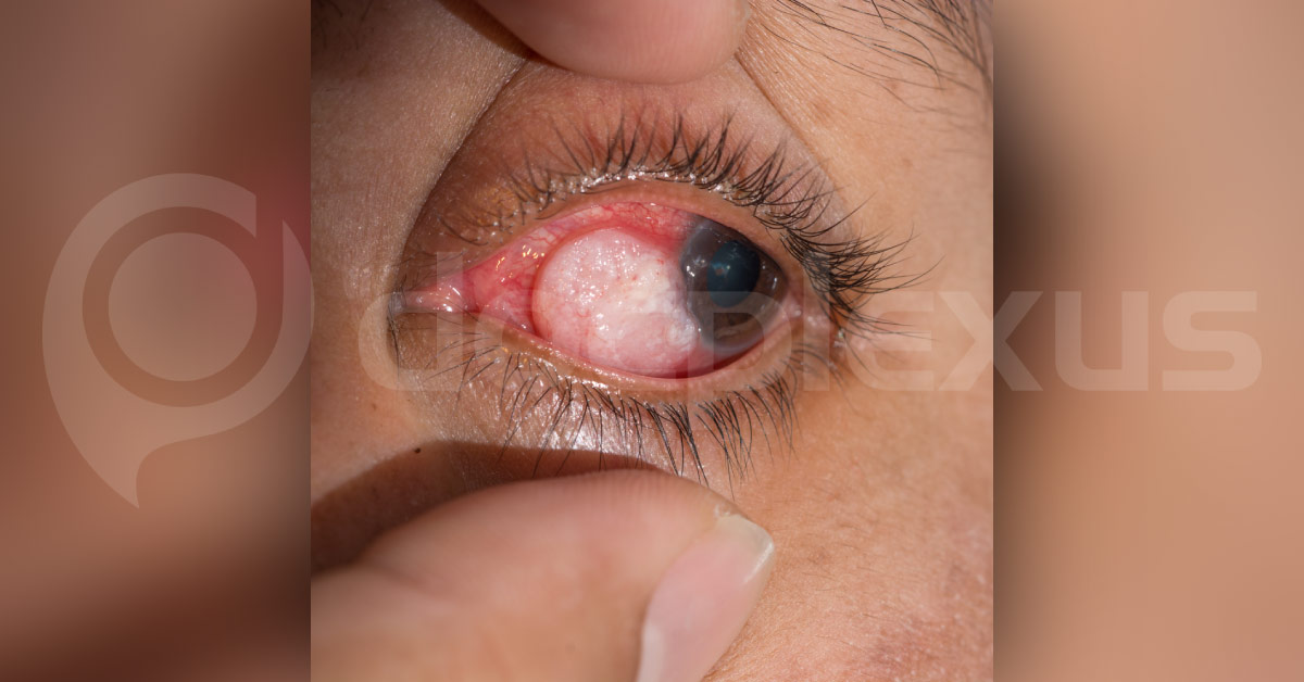 Review On Primary Tumors Of Optic Nerve And Its Sheath