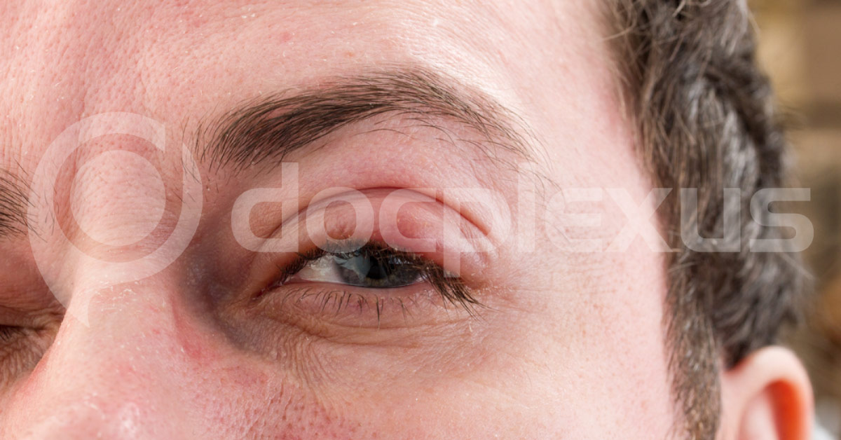 Trachoma Caused Due To Bacterial Infection