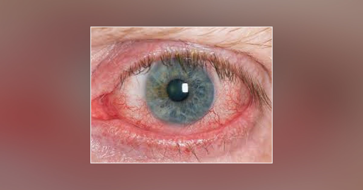 Review On Various Ophthalmic Terminologies