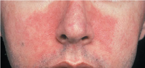 A Man With Recurrent Itchy Facial Eruption