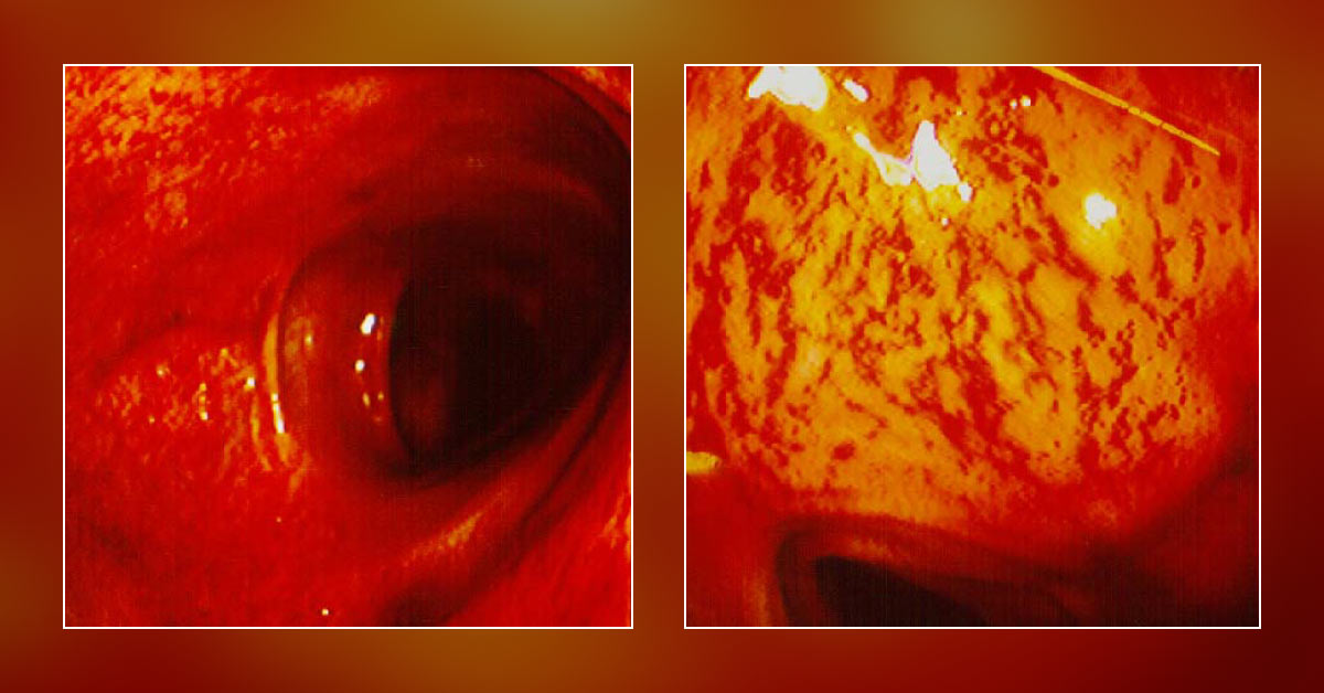 A 52-year-old Woman with Gastrointestinal Bleeding