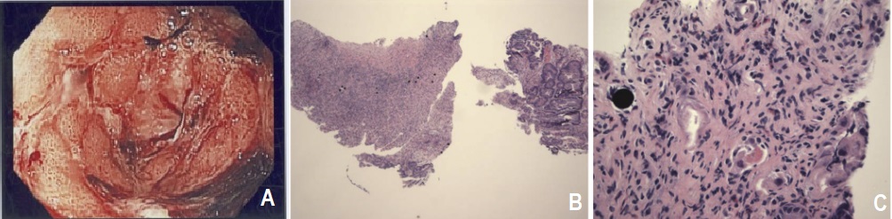 Nausea and Vomiting Following Radioembolization: What’s Your Diagnosis?
