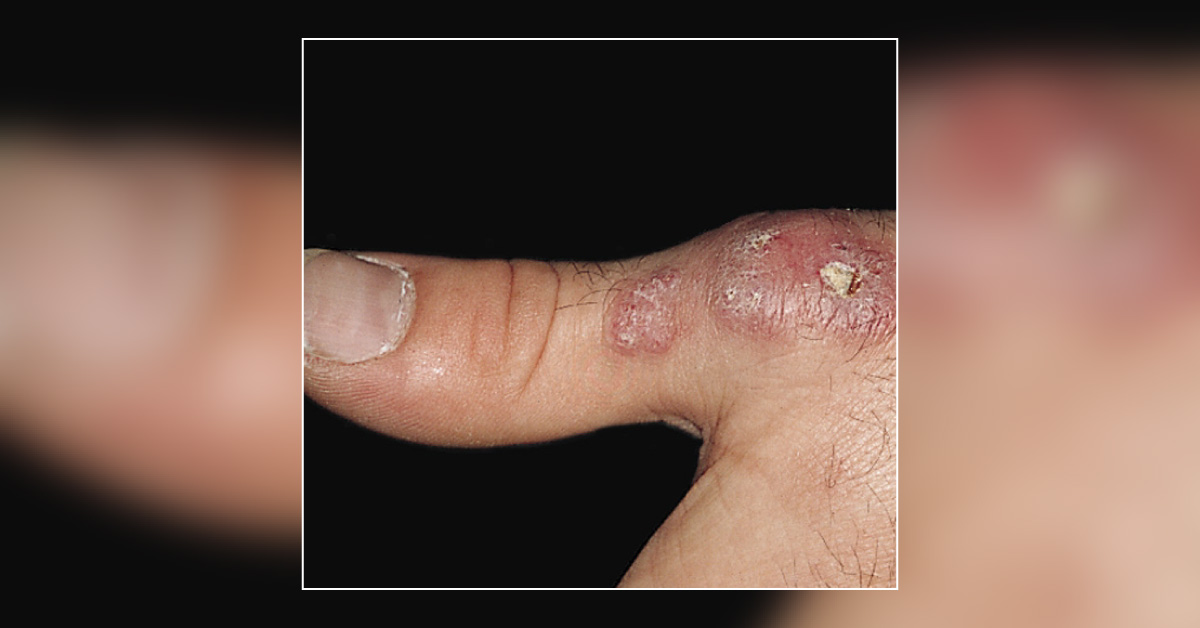 A Patient With Numerous Lesions