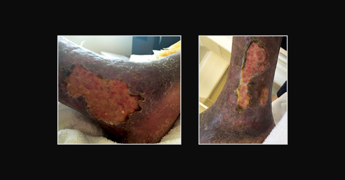 An Elderly Man with Persistent Ulceration in His Right Leg