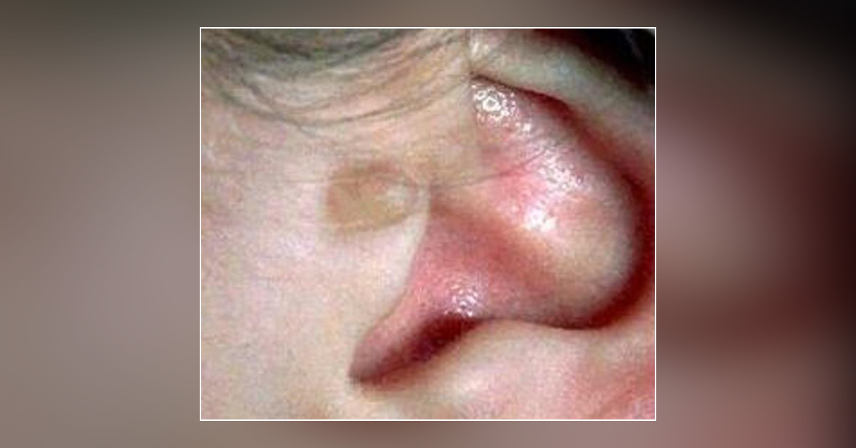 Brief Review On Goldenhar Syndrome
