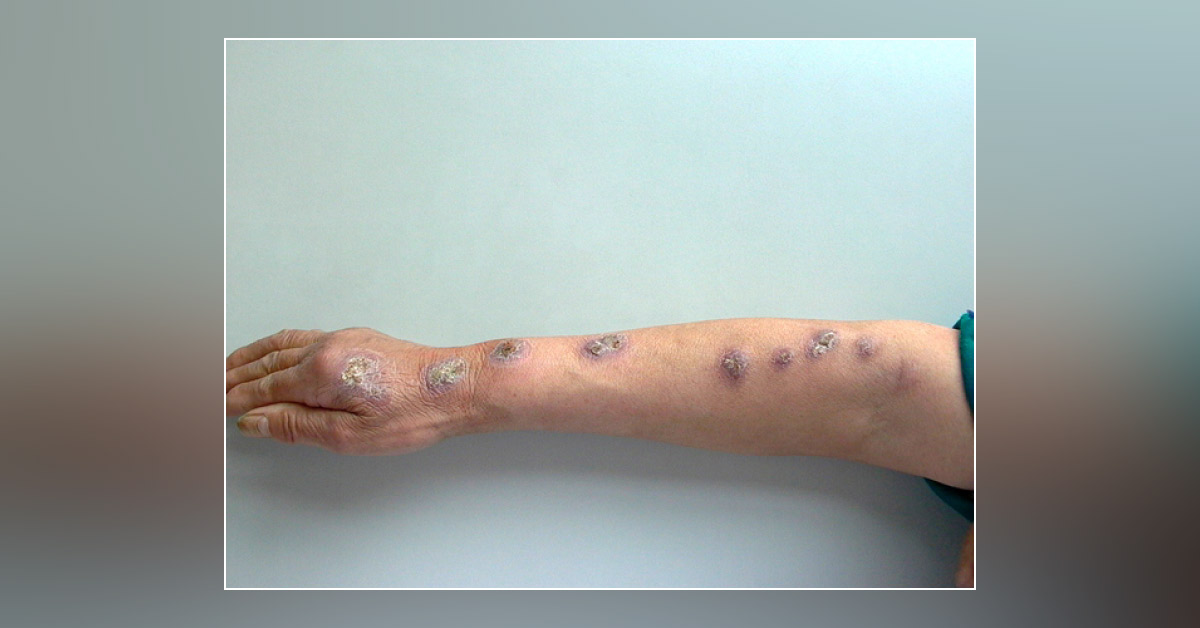 Ulcerated Patches on Hand