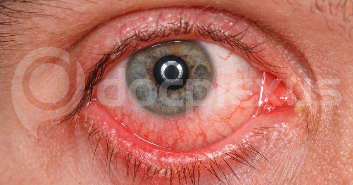 Brief Review On How To Proceed With Management Of Vernal Keratoconjunctivitis