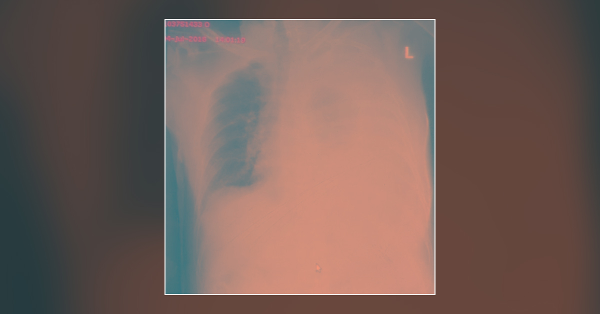 Malignant Pleural Effusion