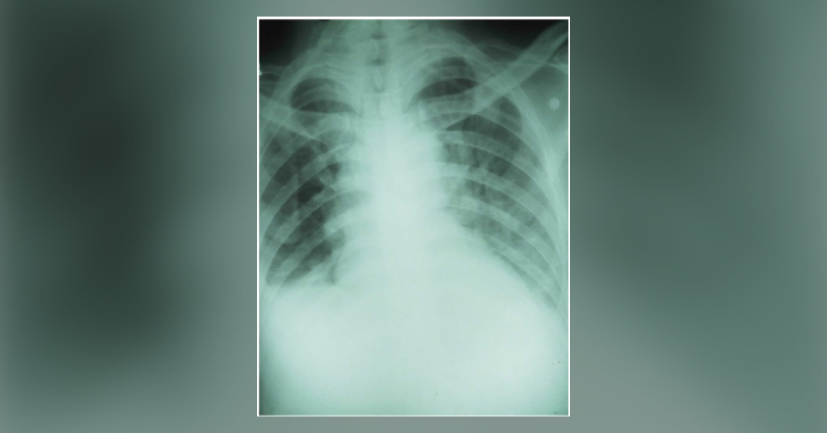 Can You Diagnose This Infection in the 57-year-old Man?