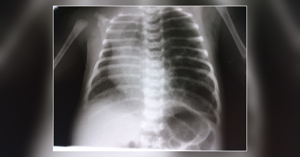 A Two Day Old Infant With Respiratory Distress