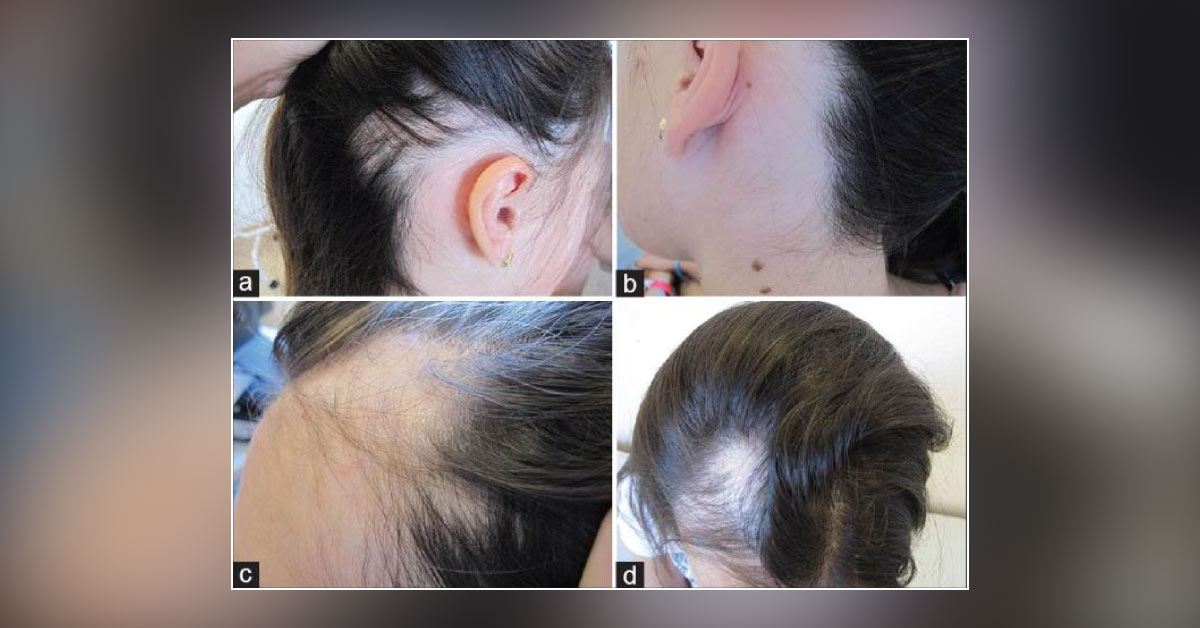 Treatment for Alopecia Areata with Greater than 50% Involvement