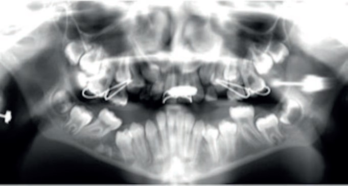 An Impacted and Submerged Second Deciduous Molar