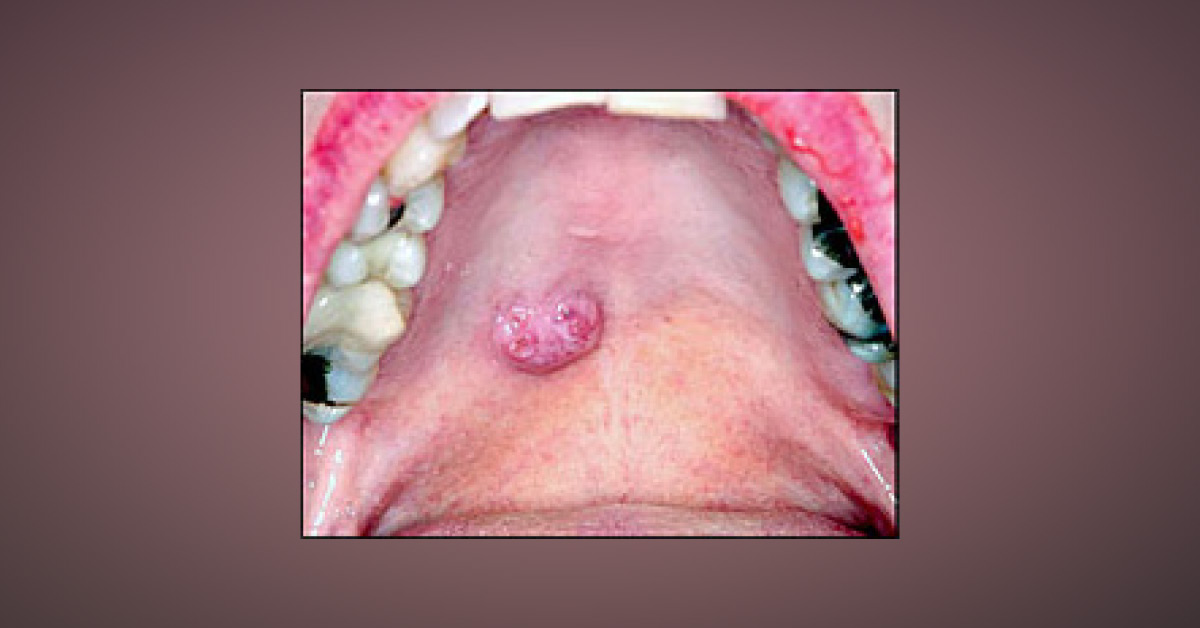 A Nodule On Palate