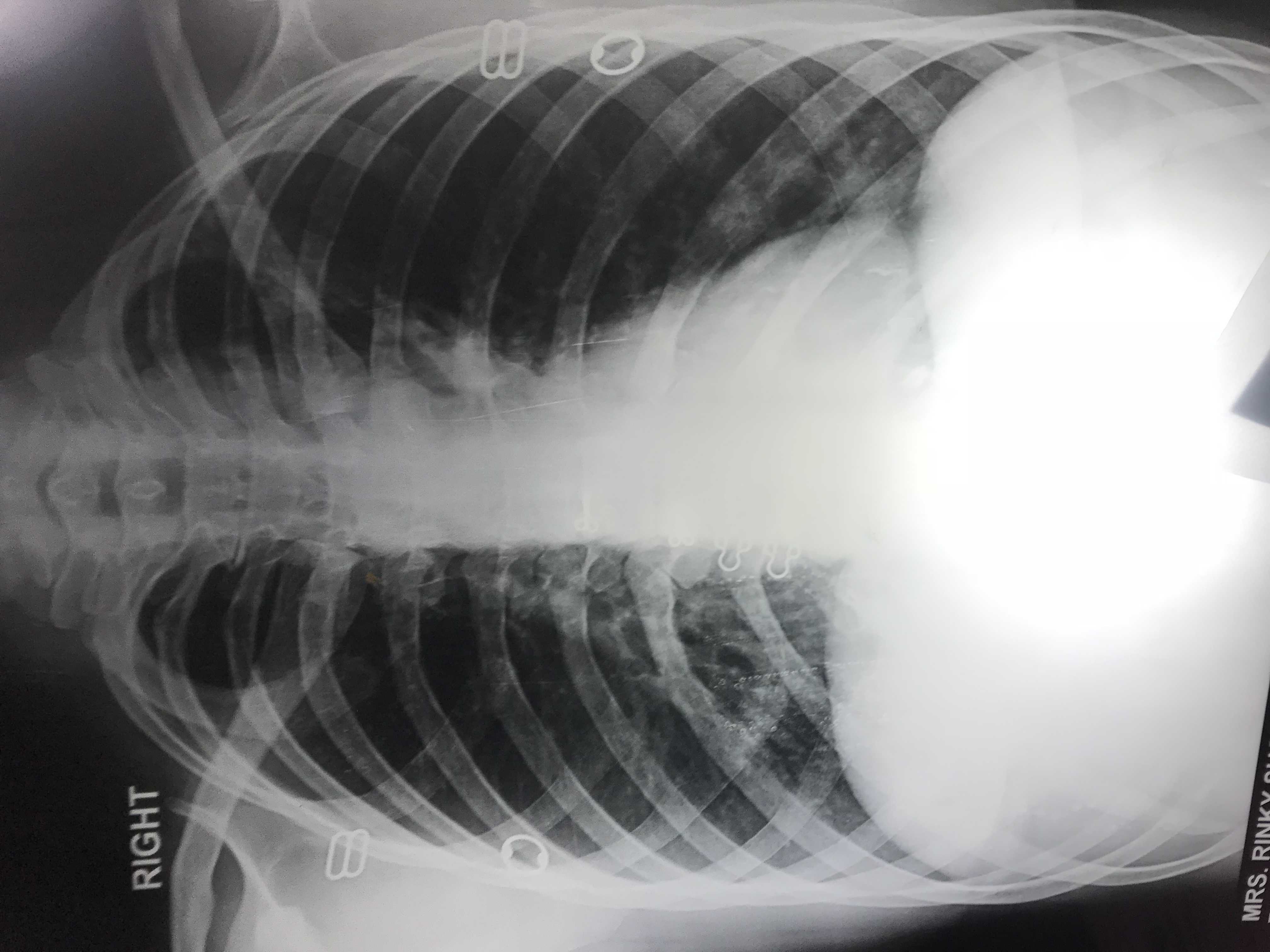 Comment On This Chest X-Ray Of Man?