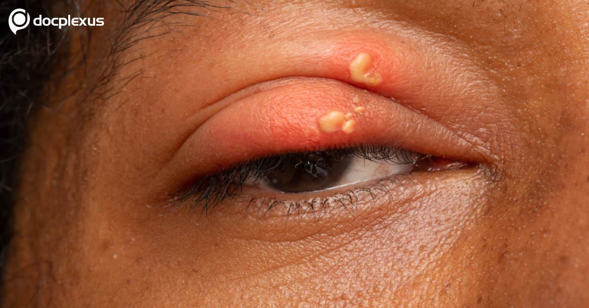 Review On Ocular Manifestations Of Herpes Simplex