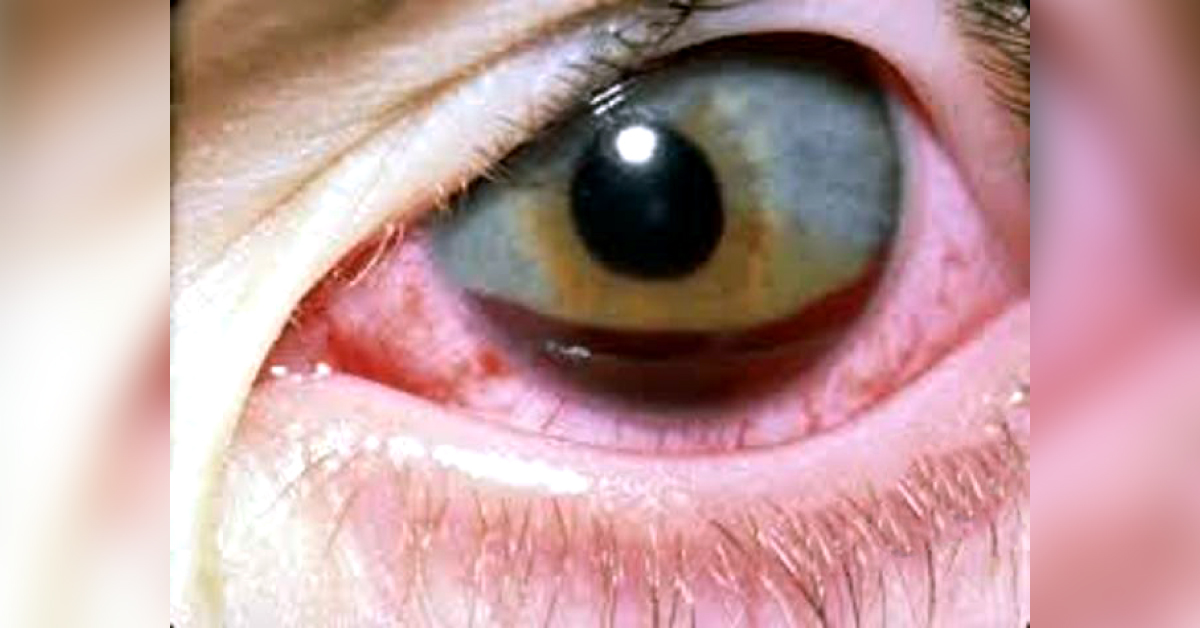 Brief Review On Pellet Hit Ocular Injuries