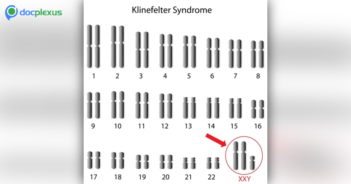 Sex Problems: What Happens in Men With Klinefelter Syndrome