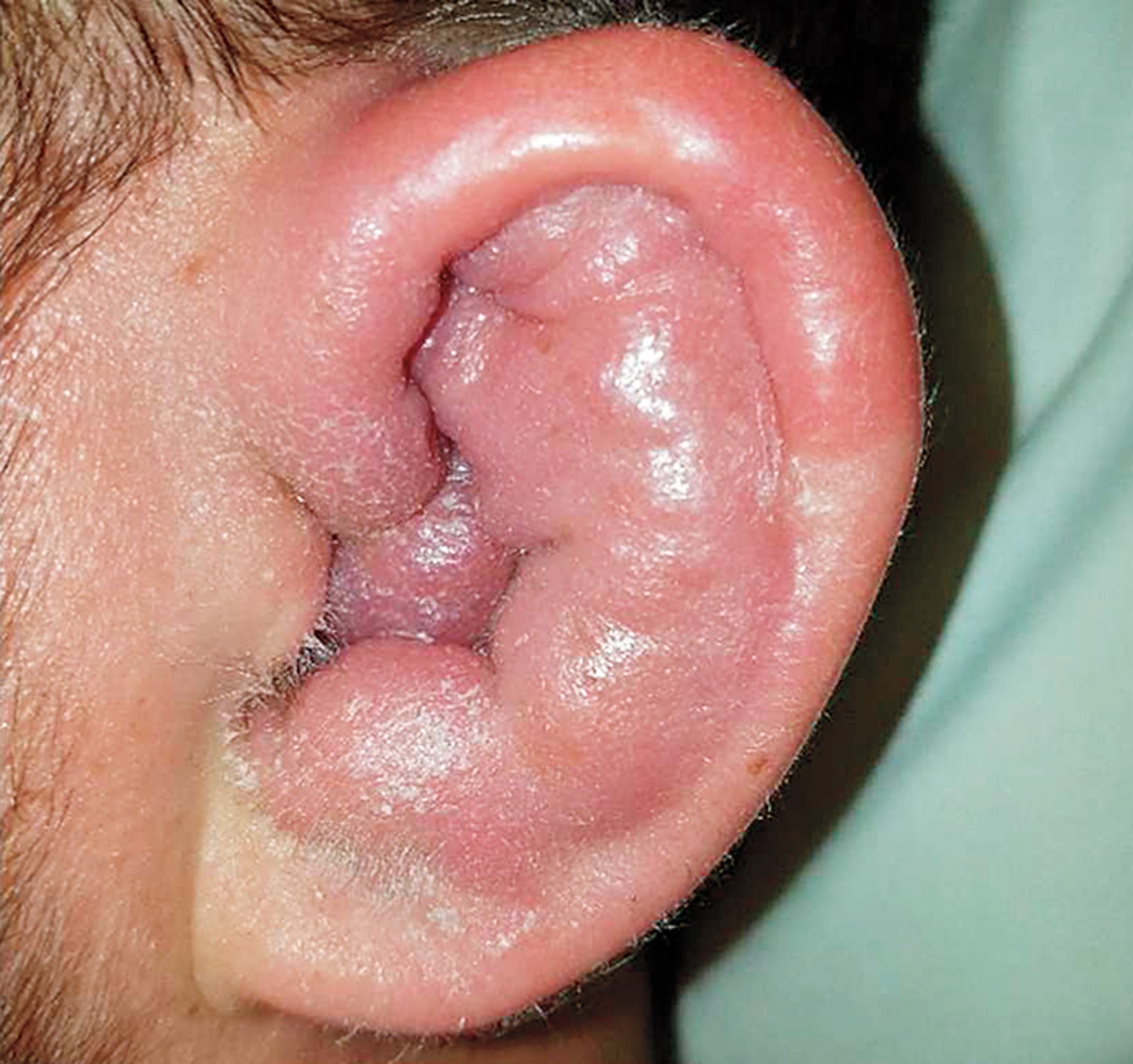 What Made his Ear Swell?