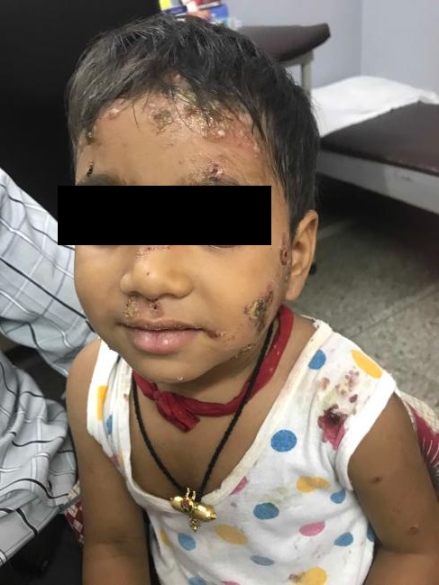 How To Treat This Severe Skin Infection? 