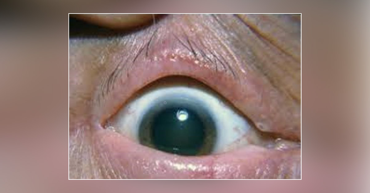 Query On Causes Of Madarosis