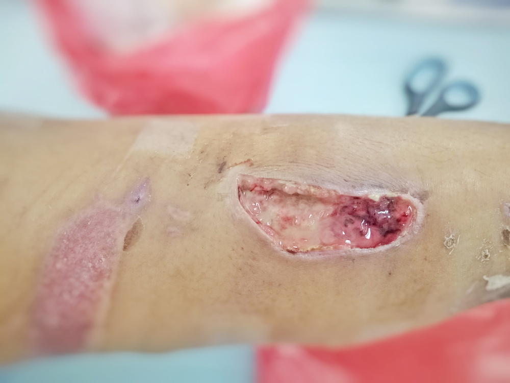 Topical Gentamicin And Antibiotic Therapy May Cure Diabetic Foot Ulcer Infection
