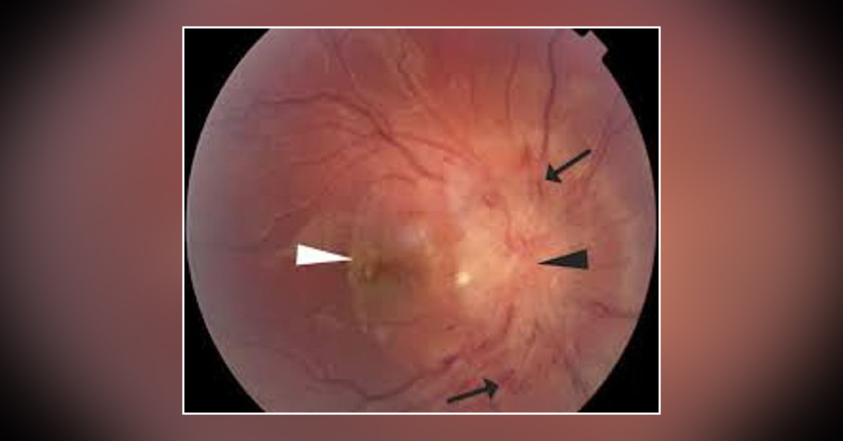Brief Review On Causes Of Angioid Streaks