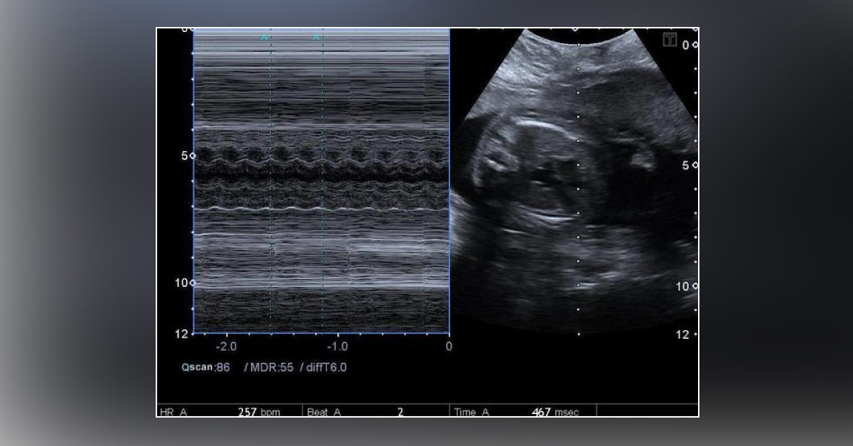 Diagnose This Patient's Condition from the Ultrasound-M Mode Image
