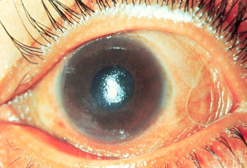 Identify Diagnosis Of This Ophthalmic Condition