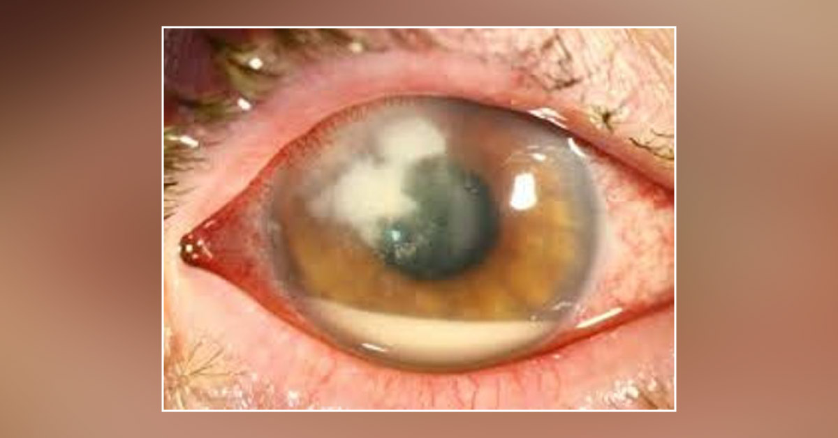 Spot The Diagnosis Of Given Ophthalmic Condition