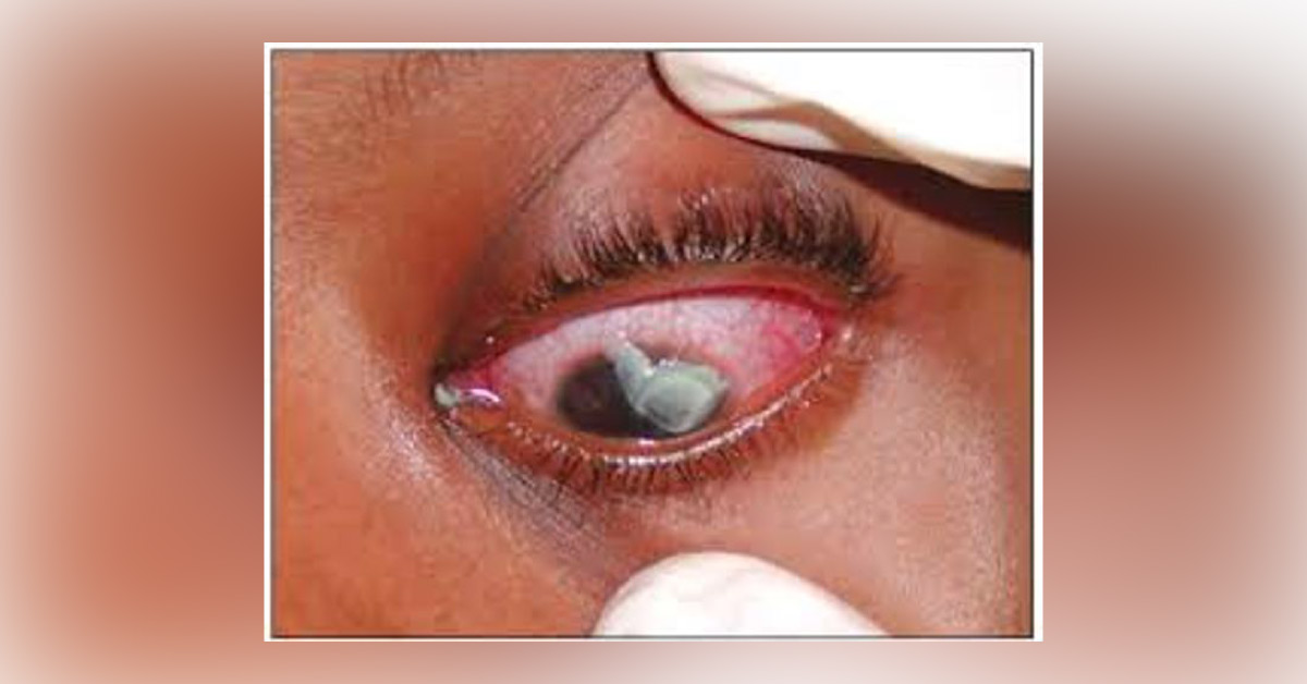 Brief Review On Causes Of Corneal Perforations