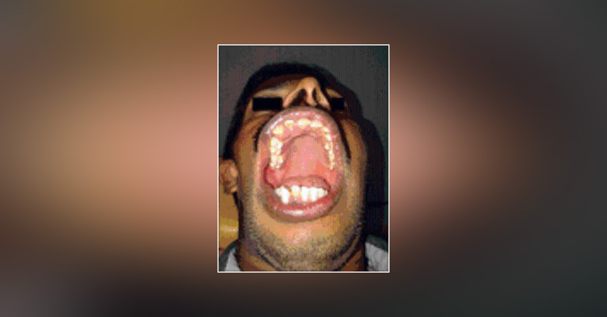 Spot the Ophthalmic Condition Associated With High Arched Palate