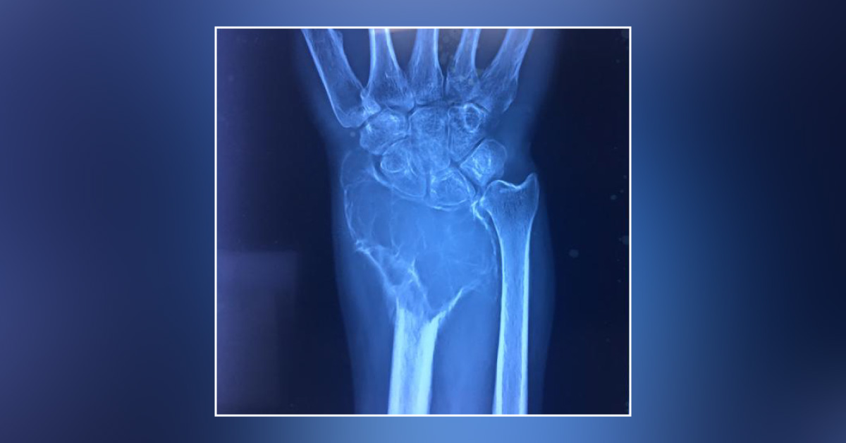 Identify This Bony Lesion