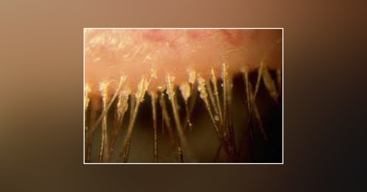 Scenario Of Pediculosis Palpebrarum Crab Louses