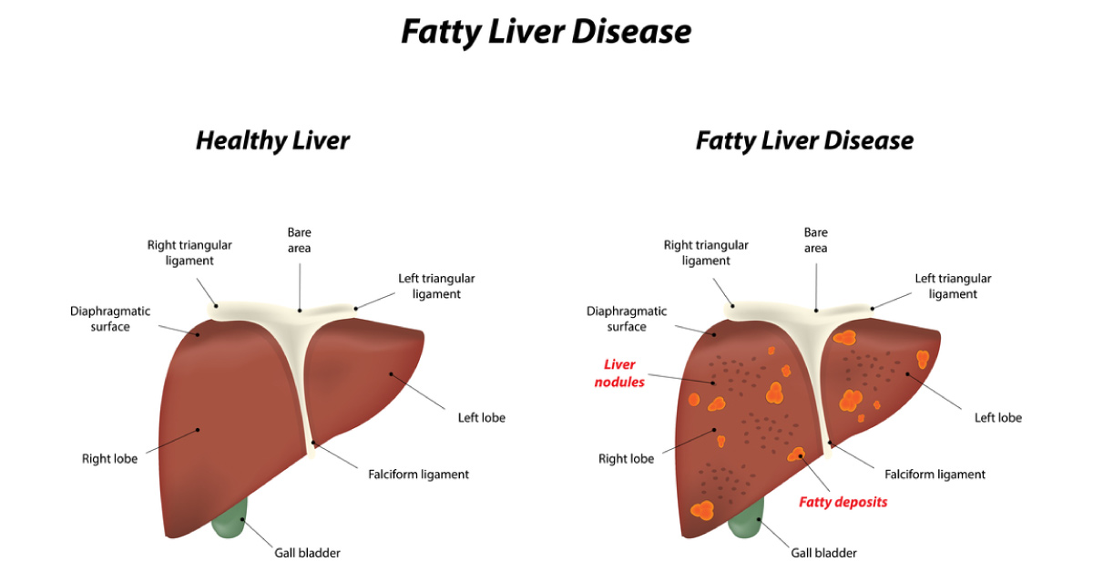 Even Light Drinking May Make Fatty Liver Disease Worse