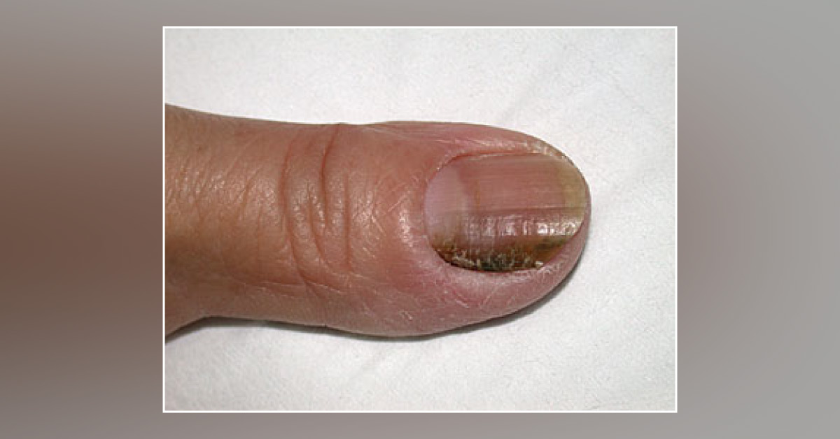 Case of a Woman with Grey Nail