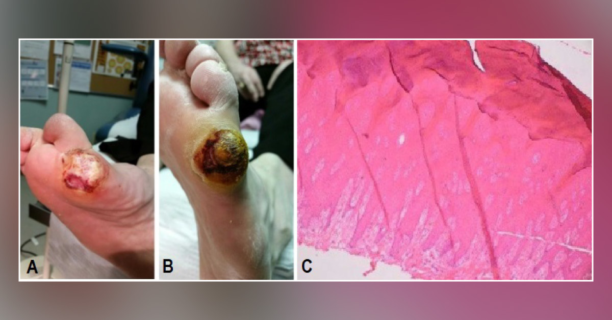 Foot Ulcers in an Uncontrolled T2DM Patient
