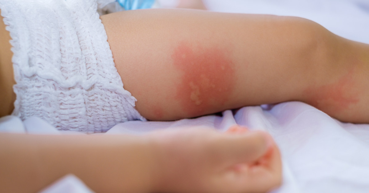 Egg Allergy In Childhood
