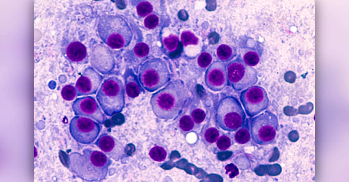 Myeloma: Frequently Asked Questions